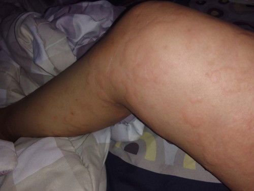 Tiba tiba bentol seluruh badan di usia kandungan 35w