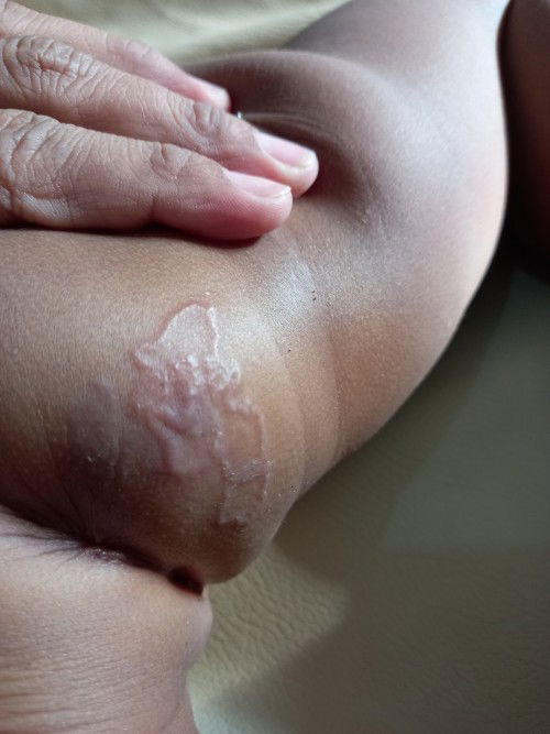 Ruam popok atau penyakit kulit?