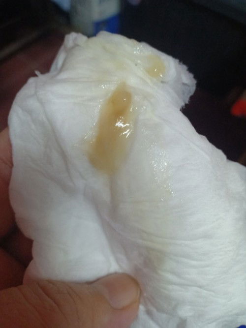 มีมูกแบบนี้ต้องทำอย่างไร?