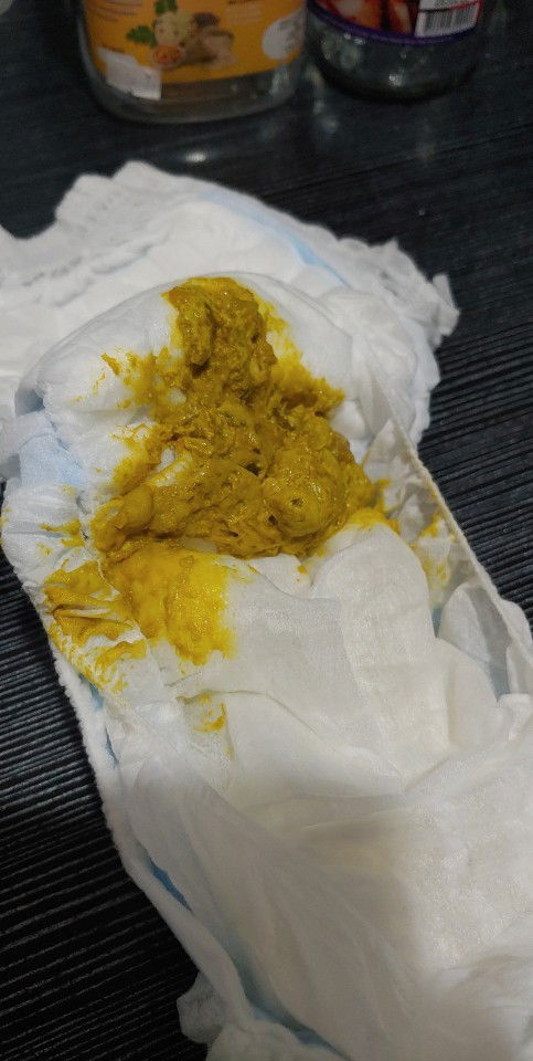 Bright yellow baby poop (Warning)