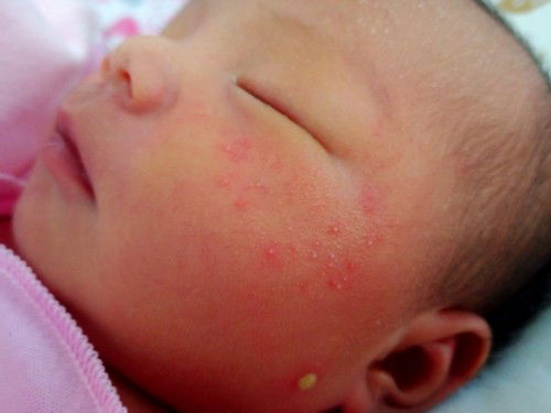 Ruam di pipi bayi