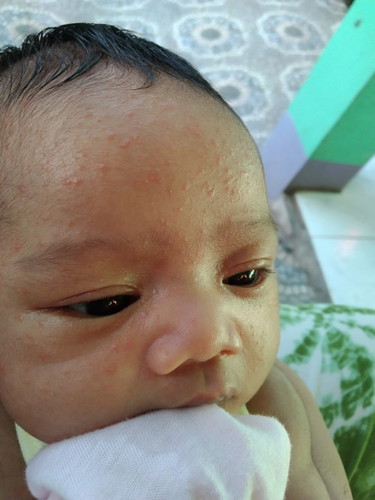 BABY ACNE OR RASHES