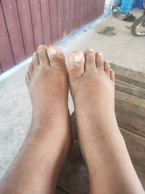 เท้าบวมจะเป็นอะไรไหมค่ะ