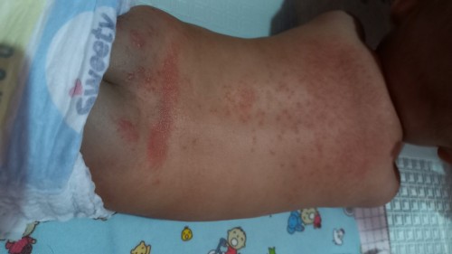 Biang keringet dan kemerahan