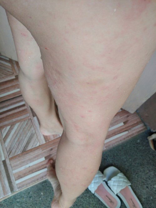 Skin Allergy