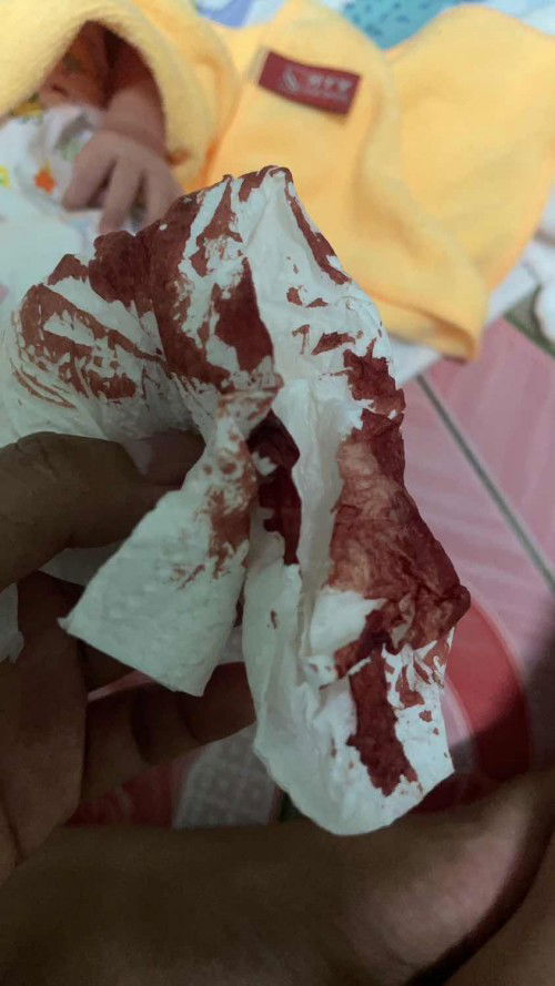 มีเลือดออกหลังผ่าคลอด