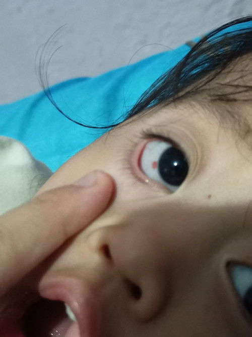 Mata anak seperti berdarah