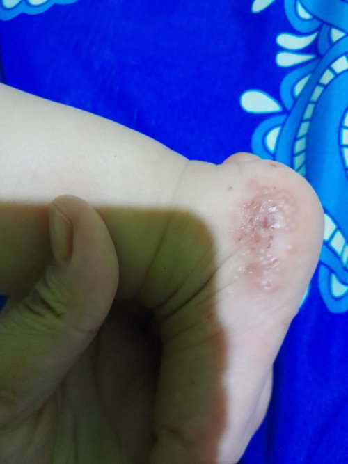 Info dong bun gini terus udah sembuh jadi lagi kaya gini terus