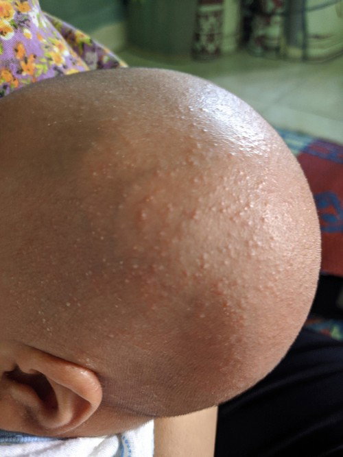 Cara mengatasi biang keringat di kepala bayi