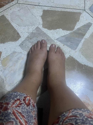 Pamamanas ng paa sa ikalimang buwan, Normal ba?