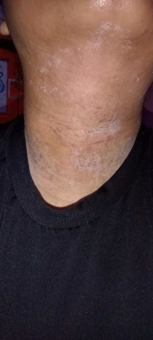 Beruntusan dan menghitam di leher