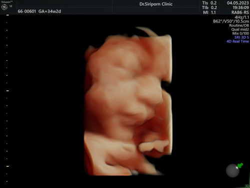 มาอวดรูปอัลตร้าซาวด์กันค่ะแม่ๆ