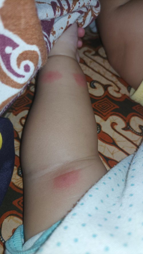 Merah pada kulit bayi