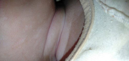 Bunda" mau tanya, cara ngilangin bekas luka pada bayi pakenya apa ya biar kulitnya rata gitu