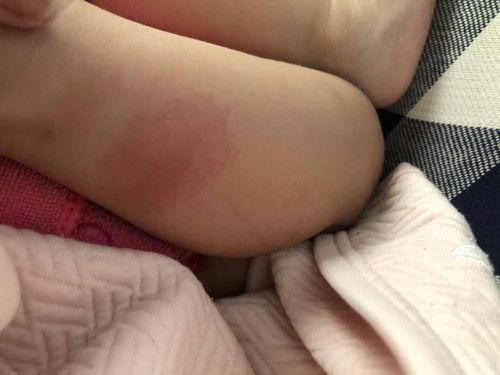 ผื่นแดงไม่เป็นๆหายๆ