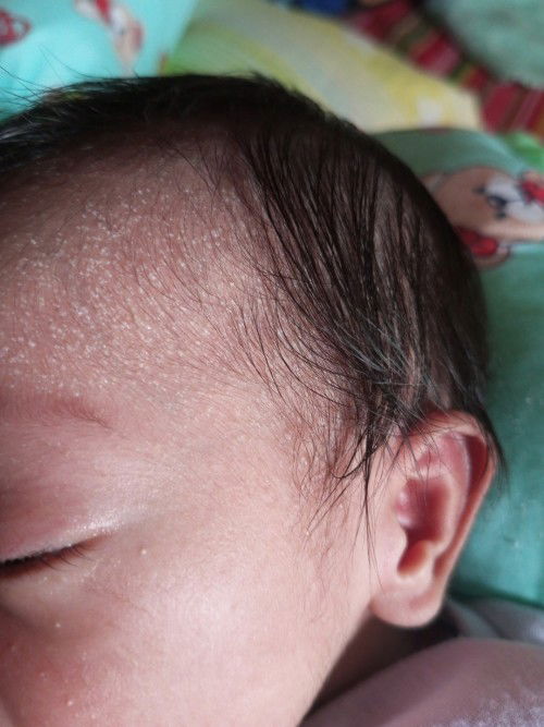 Mga mommy's 10 days old palang baby ko ano kayang biglang tumubo sa may ulo at noo butol na may tubi