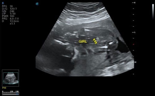 Scan baby Kena Scam jantina