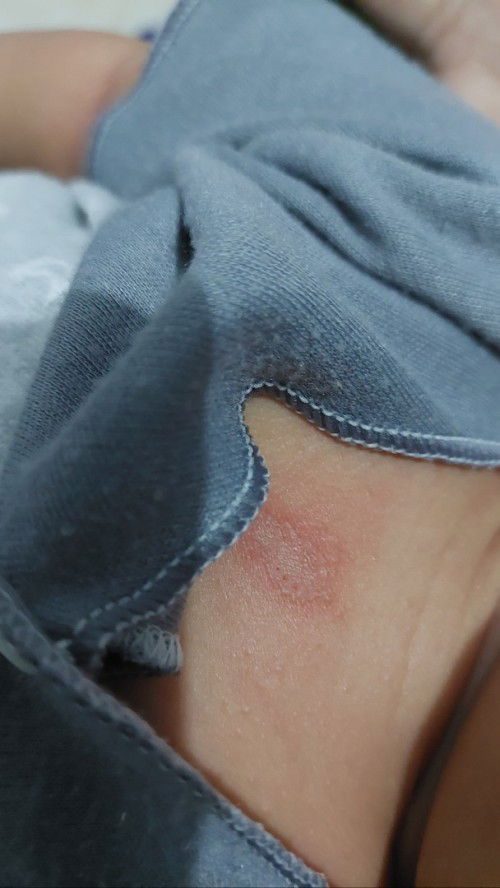 Dada bayi 1 bulan mlepuh seperti herpes