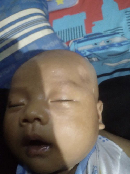 Putih kaya panu di kepala anaku