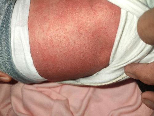 Bintik merah sebadan