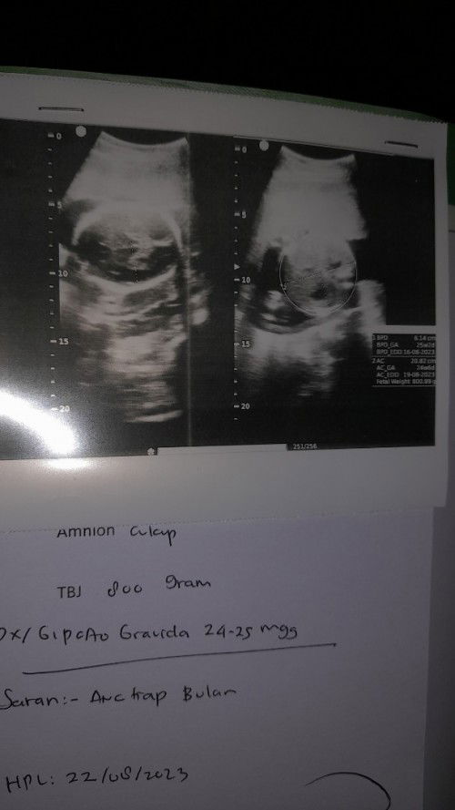 Hasil usg 80% cewe, apa bisa nanti pas lairan berubah?