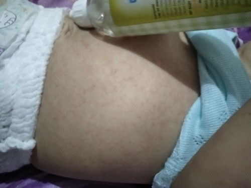 Gatal gatal dan merah pada bayi