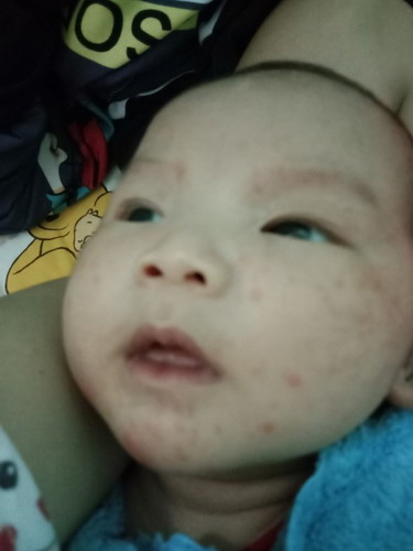 ผื่นแดงขึ้นหน้า