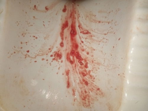 อวกเป็นเลือด 🤮😓