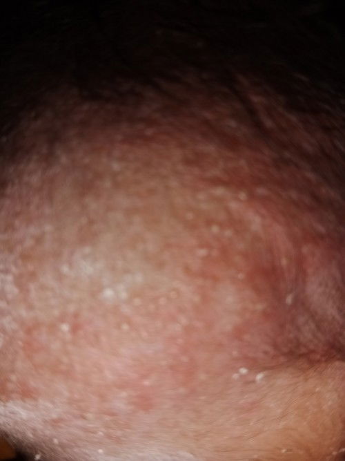 Babynya ad yg kyk gini nggk se bun.. Ya allah seluruh tubuh bnyak kyk cairan putih " Melepuh gitu..