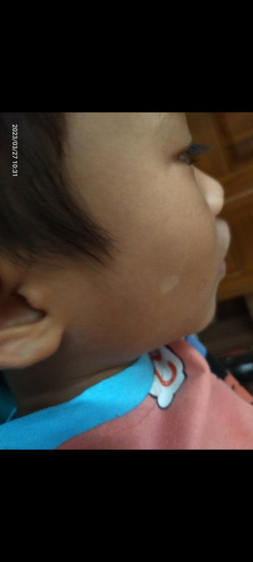 putih putih di wajah dan badan