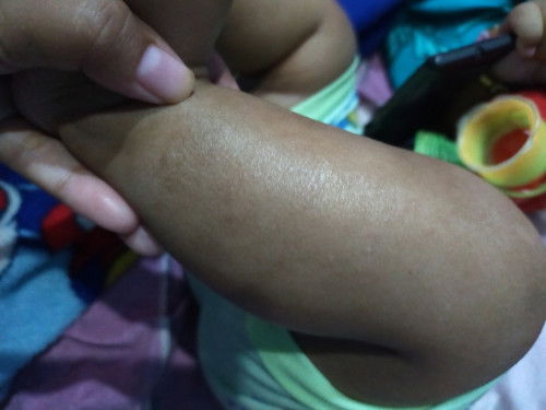 Kulit beruntusan dan kering