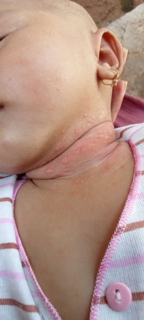 Salep untuk leherr yang iritasi