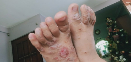 Blisters on toddler