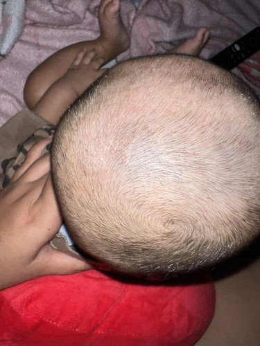 Solusi Ketombe bayi