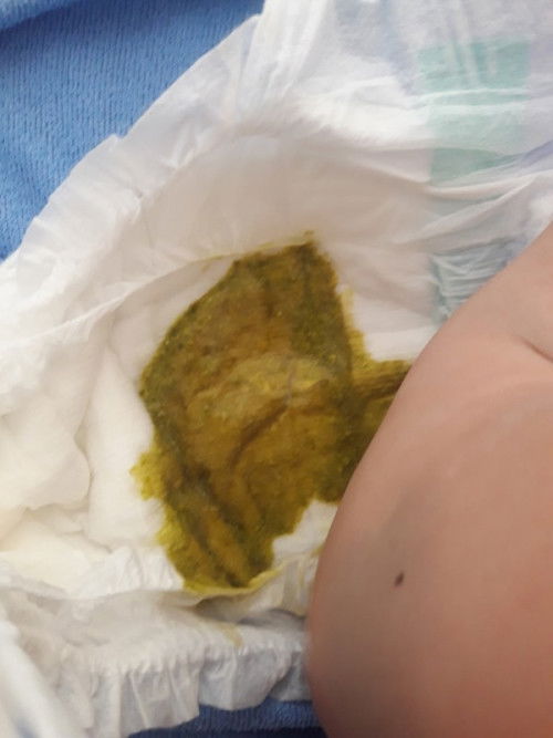 สวัสดีค่ะสอบถามหน่อยค่ะ 
เป็นอะไรค่ะ คิดว่าท้องเสียรึปาติไหมทำยังไงดี 4 เดือน 6 วัน