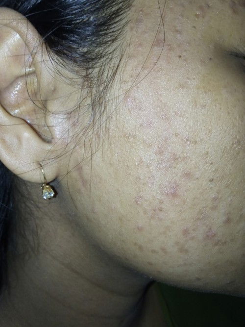 Selama hamil wajah jerawatan parah