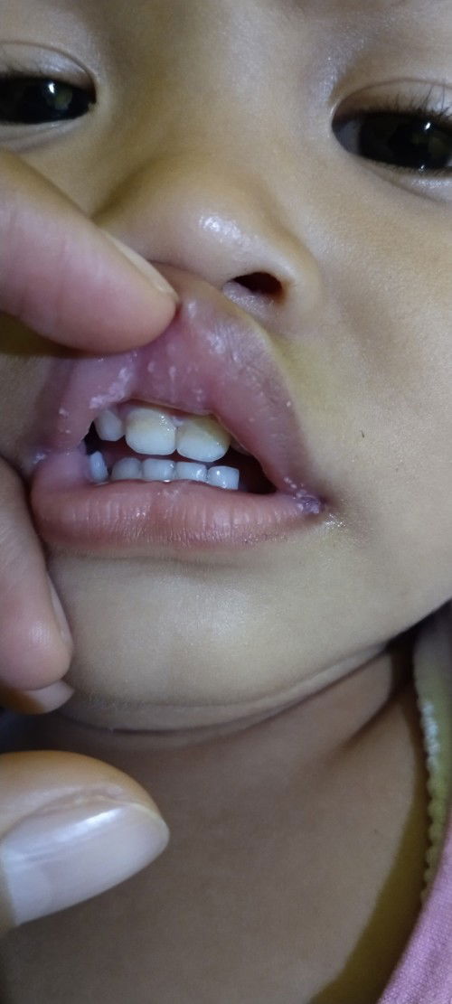 Terdapat bercak putih pada mulut anak