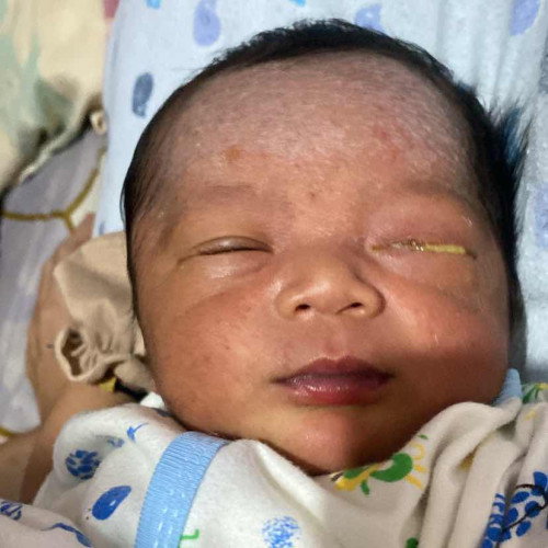 Mata bayi bengkak dan belekan