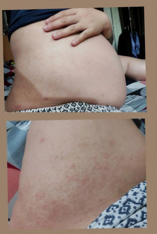 อาการคันตามผิว เหงื่อออกก็คัน