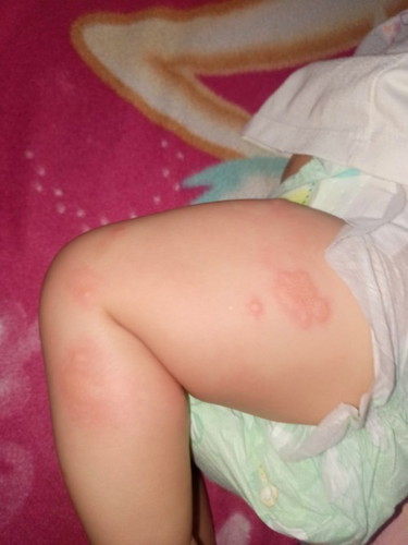 Kagat ng lamok o rashes