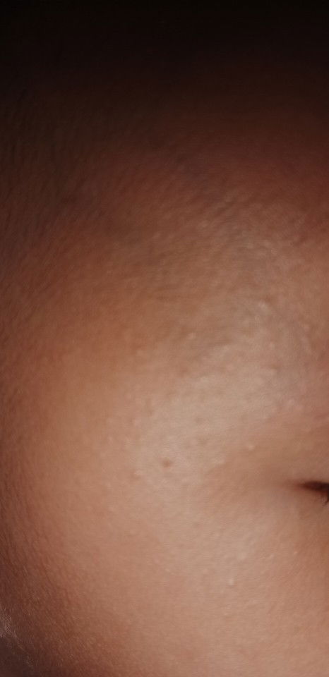 ผื่นเกิดจากอะไร เเพ้อะไรรึป่าว