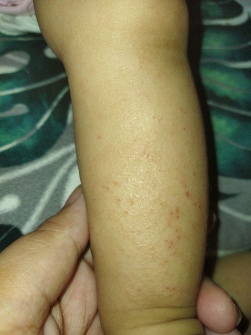 magaspang ang balat ni baby