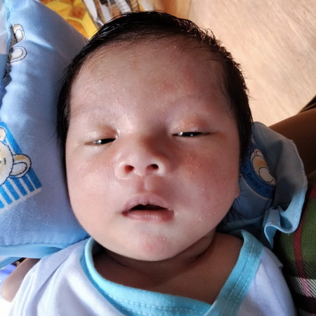 Butlig sa muka at pamumula