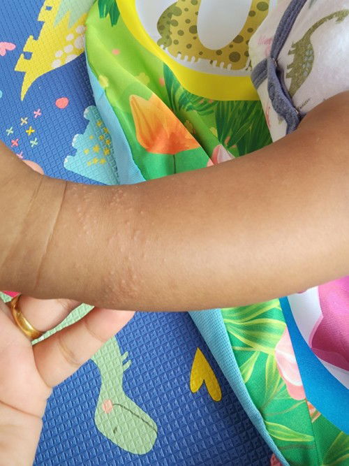 Rashes on ankle 4 month old