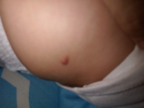 ano po kaya etong nasa tyan ng baby ko?maliit na butlig lang noon ngayon 4 months na sya ganyan napo