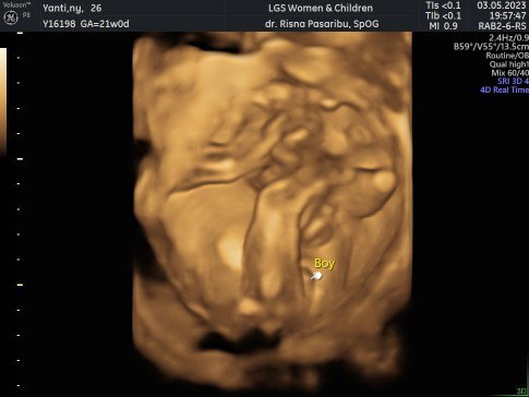 Bun ad yang pernah begini gk? Fix cowo atau kemungknan bisa cewek ya pas lahirnya