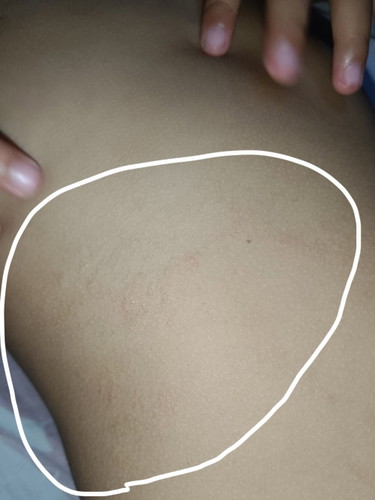 Chiken skin