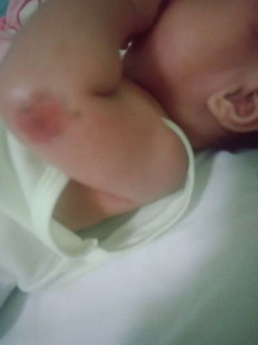 mga mie ano po kaya tong nasa braso nang baby ko?