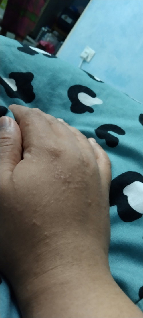 Gatal² tp xhilang...lumur garam pon sama
