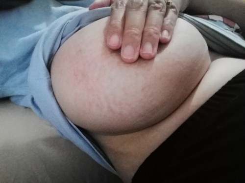 Breast stretch mark